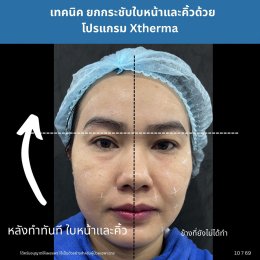 การดูแลความกระชับของผิวด้วย Program XTherma Monopolar RF