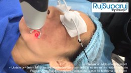 Update เทคนิคดูแลปัญหาฝ้า Melasma Treatment Update