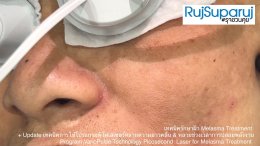 Update เทคนิคดูแลปัญหาฝ้า Melasma Treatment Update