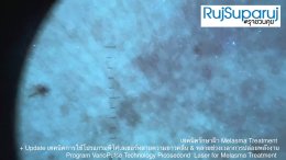Update เทคนิคดูแลปัญหาฝ้า Melasma Treatment Update