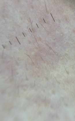 โรคโรซาเชีย Rosacea มีอาการอย่างไร และดูแลรักษาอย่างไร?