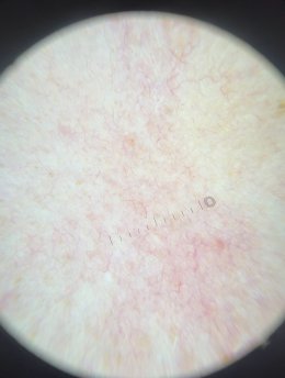 โรคโรซาเชีย Rosacea มีอาการอย่างไร และดูแลรักษาอย่างไร?