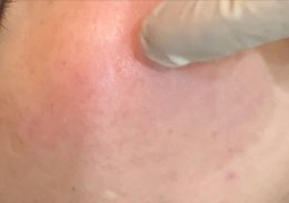 โรคโรซาเชีย Rosacea มีอาการอย่างไร และดูแลรักษาอย่างไร?