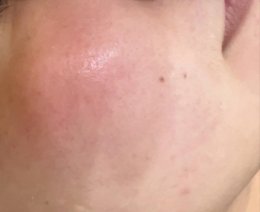 โรคโรซาเชีย Rosacea มีอาการอย่างไร และดูแลรักษาอย่างไร?