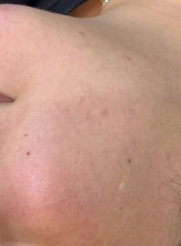 โรคโรซาเชีย Rosacea มีอาการอย่างไร และดูแลรักษาอย่างไร?