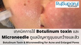 เทคนิคการใช้ Botulinum Toxin และ Microneedling ในการดูแลปัญหารูขุมขนกว้าง สิว และการฟื้นฟูคุณภาพผิว
