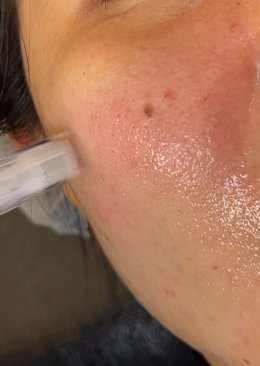 เทคนิคการใช้ Botulinum Toxin และ Microneedling ในการดูแลปัญหารูขุมขนกว้าง สิว และการฟื้นฟูคุณภาพผิว