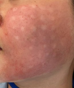 เทคนิคการใช้ Botulinum Toxin และ Microneedling ในการดูแลปัญหารูขุมขนกว้าง สิว และการฟื้นฟูคุณภาพผิว