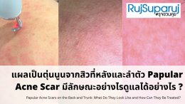 แผลเป็นตุ่นนูนจากสิวที่หลังและลำตัว Papular Acne Scar มีลักษณะอย่างไรดูแลได้อย่างไร ?