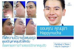 ขอบคุณ คุณนุชา #happynucha ที่ให้ความไว้วางใจหมอรุจ ดูแลปัญหาหลุมสิวให้ครับ / อัพเดทผลการทำเลเซอร์รักษาหลุมสิว /