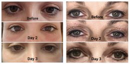 แก้ปัญหาหนังตาตก ตาสองชั้นหลบในโดยไม่ต้องผ่าตัดด้วย “Plasma eyelift” Plasma eyelift: Non surgical double eyes lit (blepharoplasty)