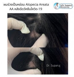 ภาวะผมร่วงเป็นหย่อม Alopecia Areata AA หลังฉีดวัคซีนโควิด-19 เกิดจากอะไรดูแลได้ อย่างไร?