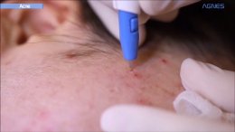 ดูแลรักษาสิวด้วยเทคนิคเข็มคลื่นวิทยุทำลายต่อมไขมัน Micro Insulated Needle RF Acne Resolve