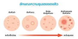 แผลเป็นหลุมสิวที่จมูก ดูแลได้อย่างไรบ้าง ?