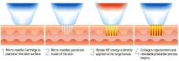 Fractional Radio Frequency RF คืออะไร มีกี่ชนิด แตกต่างกันอย่างไร ?