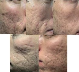 Update เทคนิค Subcision ตัดพังผืดรักษาหลุมสิว Acne Scar Subcision Techniques