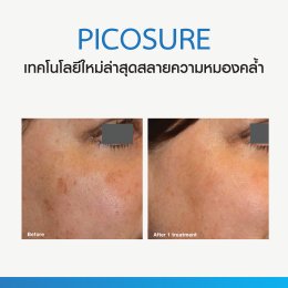 Review Picosure ใหม่ล่าสุด
