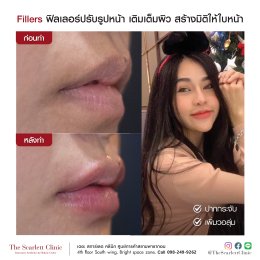 Review Facial Design by Fillers