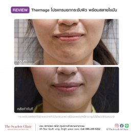 Review Thermage Total
