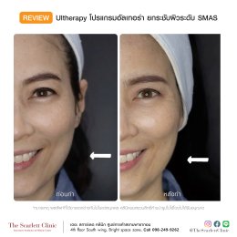 Review Ulthera ยกกระชับผิว