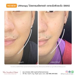 Review Ulthera ยกกระชับผิว