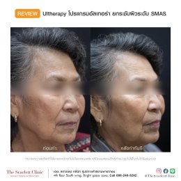 Review Ulthera ยกกระชับผิว