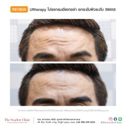 Review Ulthera ยกกระชับผิว