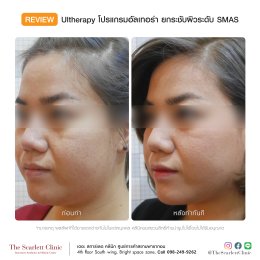 Review Ulthera ยกกระชับผิว