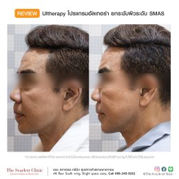 Review Ulthera ยกกระชับผิว