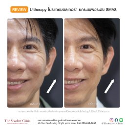 Review Ulthera ยกกระชับผิว