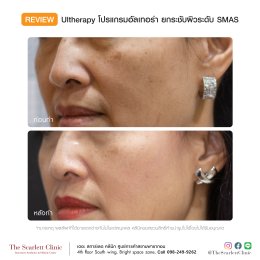 Review Ulthera ยกกระชับผิว