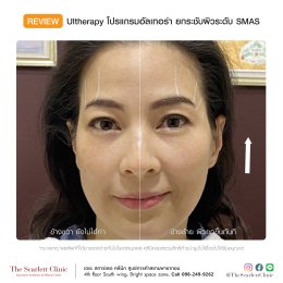Review Ulthera ยกกระชับผิว
