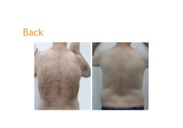 hair removal max