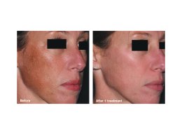 picosure