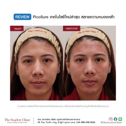 Review Picosure ใหม่ล่าสุด