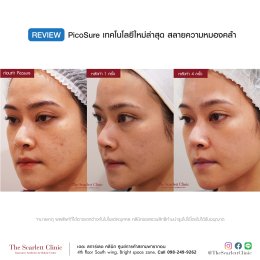 Review Picosure ใหม่ล่าสุด