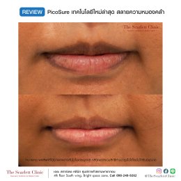 Review Picosure ใหม่ล่าสุด