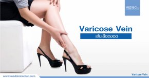 โปรแกรมรักษาเส้นเลือดขอด (Varicose vein)