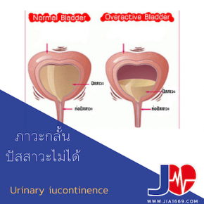 urinary incontinence ภาวะกลั้นน้ำปัสสาวะไม่ได้