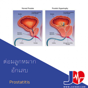 Prostatitis โรคต่อมลูกหมากอักเสบ