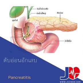 Pancreatitis ตับอ่อนอักเสบ