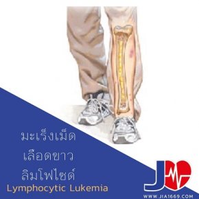Acute Lymphocytic Leukemia ALL