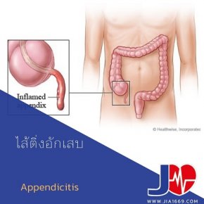 ไส้ติ่งอักเสบ Appendicitis