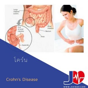 โรคโคร์น(Crohn's Disease)