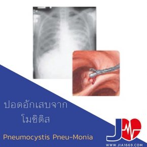 ปอดอักเสบจากนิวโมซิสติส(Pneumocystis pneu- monia)