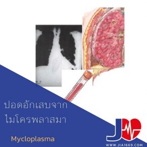 ปอดอักเสบจากเชื้อไมโครพลาสมา(mycloplasma)
