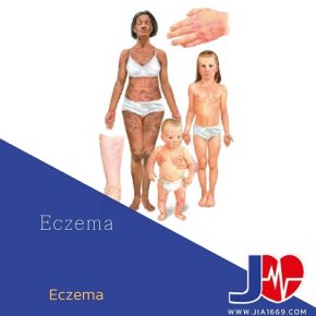 Eczema โรคผิวหนังอักเสบ