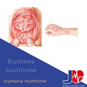 Erythema multiforme โรคผื่นแพ้ยา EM