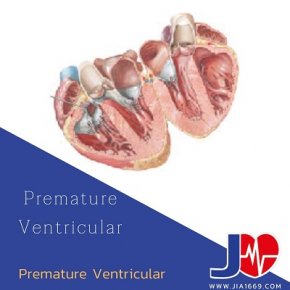 Premature Ventricular Contractions (PVCs)