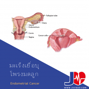 Endometrial Cancer 